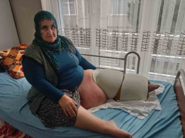 Fil hastalığı bacağını 100 kilo yaptı, tedavisinin devamı için destek bekliyor
